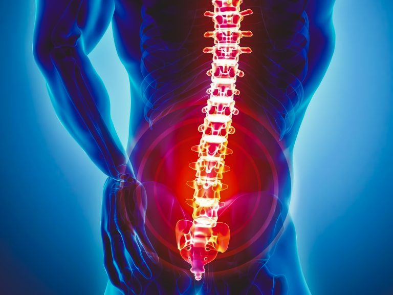 Spondylitis Management